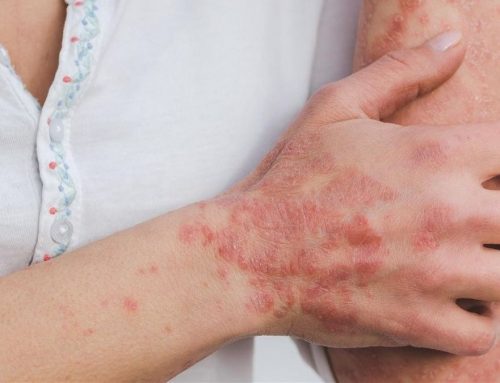 MECS TAKES CARE OF YOUR HEALTH – SCABIES
